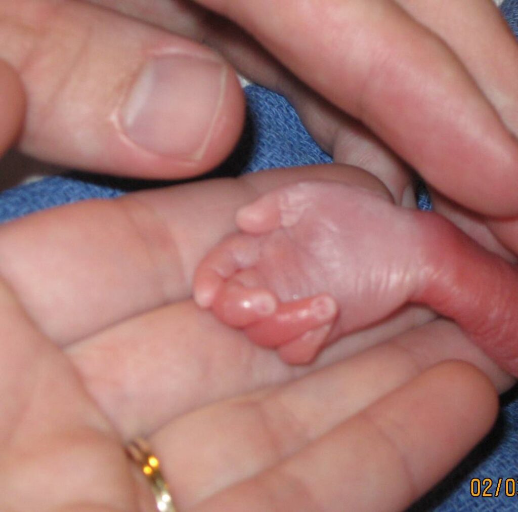 a tiny stillborn baby hand